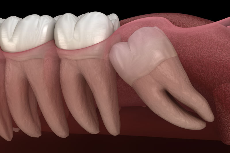 impacted wisdom tooth model